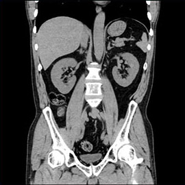 CT撮影画像腹部2