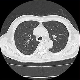 CT撮影画像胸部1