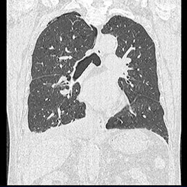 CT撮影画像胸部2