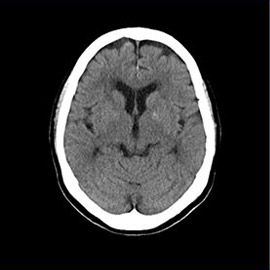 CT撮影画像頭部1