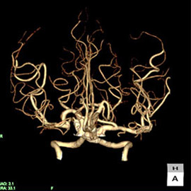 CT撮影画像頭部2