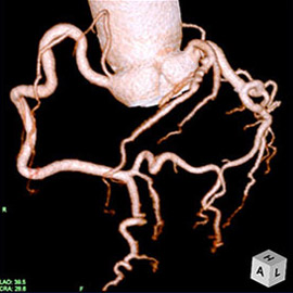 CT撮影画像心臓（冠動脈）2