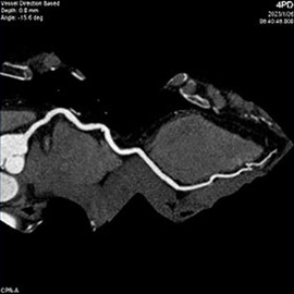 CT撮影画像心臓（冠動脈）3